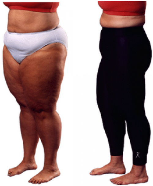 a1sx2_Thumbnail1_leggings-cellulite.png a1sx2_Thumbnail1_leggings-cellulite.png